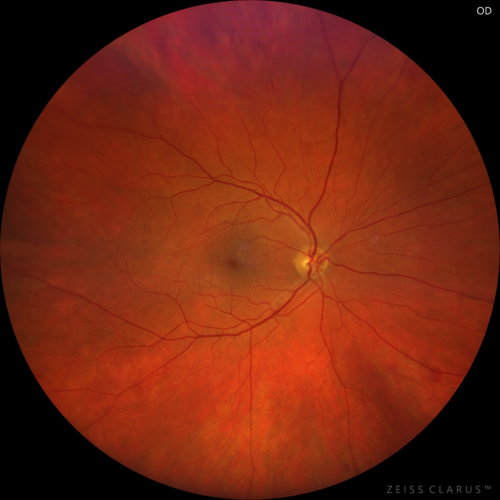 PDR and Vitreous Hemorrhage - High Risk Left Eye - Low Risk Right Eye
50 year old man with type I diabetes mellitus for 26 years.  New Vitreous Hemorrhage in the left eye.  Both eyes have NVE.  Both also have foveal hypoplasia
