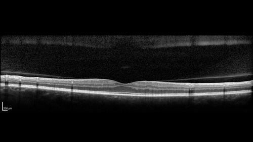PDR and Vitreous Hemorrhage - High Risk Left Eye - Low Risk Right Eye
50 year old man with type I diabetes mellitus for 26 years.  New Vitreous Hemorrhage in the left eye.  Both eyes have NVE.  Both also have foveal hypoplasia
