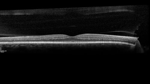 PDR and Vitreous Hemorrhage - High Risk Left Eye - Low Risk Right Eye
50 year old man with type I diabetes mellitus for 26 years.  New Vitreous Hemorrhage in the left eye.  Both eyes have NVE.  Both also have foveal hypoplasia
