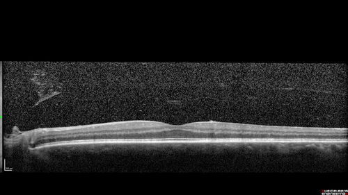 PDR and Vitreous Hemorrhage - High Risk Left Eye - Low Risk Right Eye
50 year old man with type I diabetes mellitus for 26 years.  New Vitreous Hemorrhage in the left eye.  Both eyes have NVE.  Both also have foveal hypoplasia
