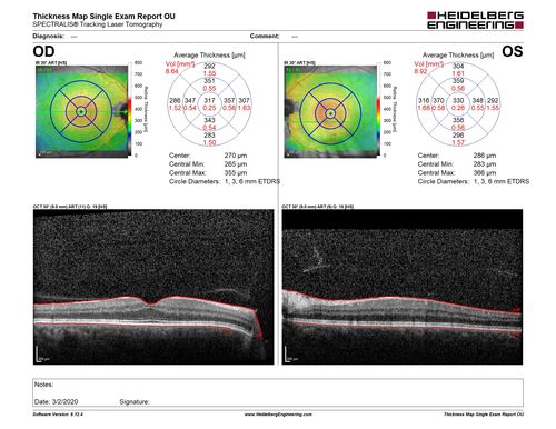 PDR and Vitreous Hemorrhage - High Risk Left Eye - Low Risk Right Eye
50 year old man with type I diabetes mellitus for 26 years.  New Vitreous Hemorrhage in the left eye.  Both eyes have NVE.  Both also have foveal hypoplasia
