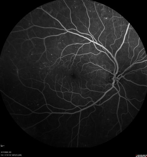 PDR and Vitreous Hemorrhage - High Risk Left Eye - Low Risk Right Eye
50 year old man with type I diabetes mellitus for 26 years.  New Vitreous Hemorrhage in the left eye.  Both eyes have NVE.  Both also have foveal hypoplasia
