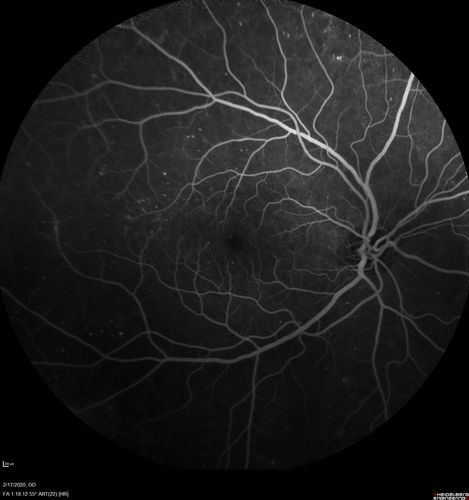 PDR and Vitreous Hemorrhage - High Risk Left Eye - Low Risk Right Eye
50 year old man with type I diabetes mellitus for 26 years.  New Vitreous Hemorrhage in the left eye.  Both eyes have NVE.  Both also have foveal hypoplasia
