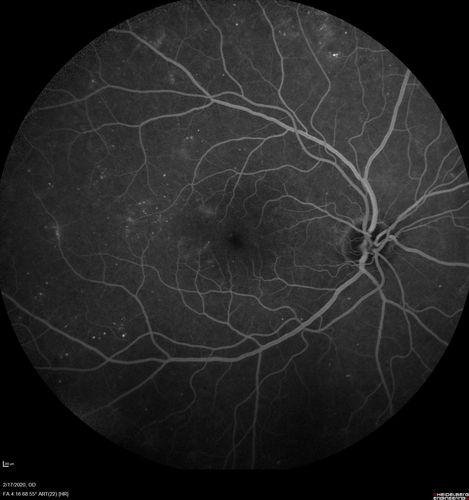 PDR and Vitreous Hemorrhage - High Risk Left Eye - Low Risk Right Eye
50 year old man with type I diabetes mellitus for 26 years.  New Vitreous Hemorrhage in the left eye.  Both eyes have NVE.  Both also have foveal hypoplasia
