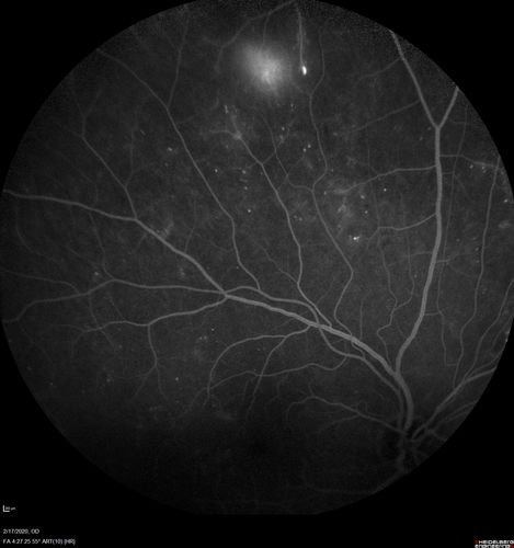 PDR and Vitreous Hemorrhage - High Risk Left Eye - Low Risk Right Eye
50 year old man with type I diabetes mellitus for 26 years.  New Vitreous Hemorrhage in the left eye.  Both eyes have NVE.  Both also have foveal hypoplasia
