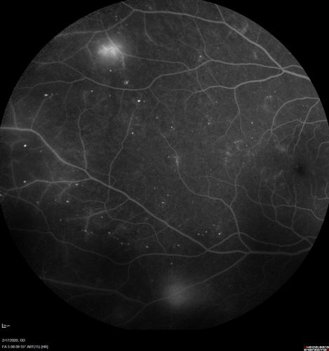PDR and Vitreous Hemorrhage - High Risk Left Eye - Low Risk Right Eye
50 year old man with type I diabetes mellitus for 26 years.  New Vitreous Hemorrhage in the left eye.  Both eyes have NVE.  Both also have foveal hypoplasia
