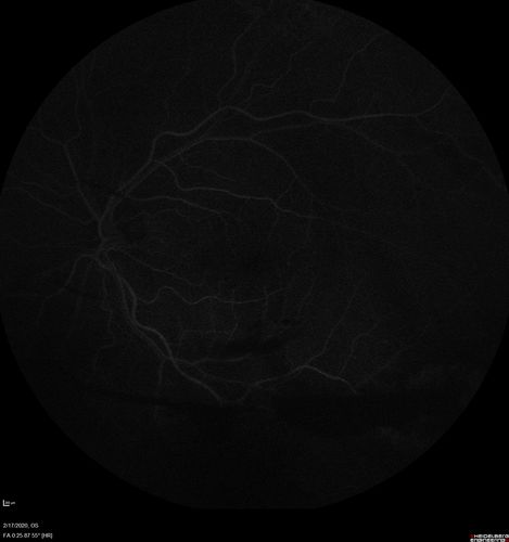 PDR and Vitreous Hemorrhage - High Risk Left Eye - Low Risk Right Eye
50 year old man with type I diabetes mellitus for 26 years.  New Vitreous Hemorrhage in the left eye.  Both eyes have NVE.  Both also have foveal hypoplasia
