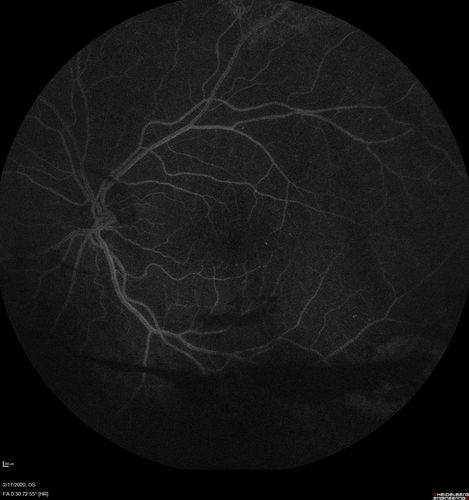 PDR and Vitreous Hemorrhage - High Risk Left Eye - Low Risk Right Eye
50 year old man with type I diabetes mellitus for 26 years.  New Vitreous Hemorrhage in the left eye.  Both eyes have NVE.  Both also have foveal hypoplasia
