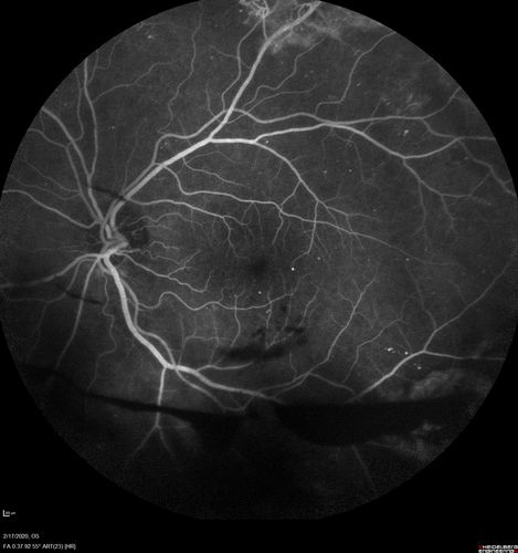 PDR and Vitreous Hemorrhage - High Risk Left Eye - Low Risk Right Eye
50 year old man with type I diabetes mellitus for 26 years.  New Vitreous Hemorrhage in the left eye.  Both eyes have NVE.  Both also have foveal hypoplasia
