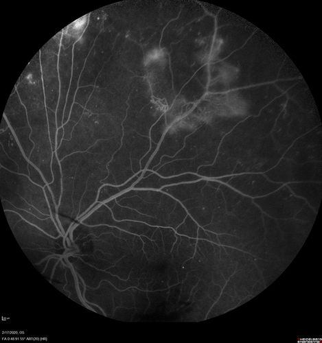 PDR and Vitreous Hemorrhage - High Risk Left Eye - Low Risk Right Eye
50 year old man with type I diabetes mellitus for 26 years.  New Vitreous Hemorrhage in the left eye.  Both eyes have NVE.  Both also have foveal hypoplasia
