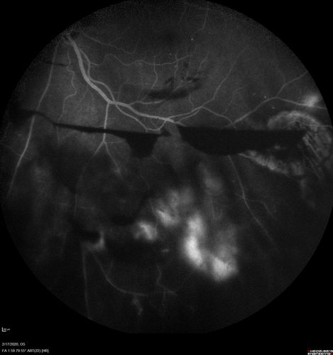 PDR and Vitreous Hemorrhage - High Risk Left Eye - Low Risk Right Eye
50 year old man with type I diabetes mellitus for 26 years.  New Vitreous Hemorrhage in the left eye.  Both eyes have NVE.  Both also have foveal hypoplasia
