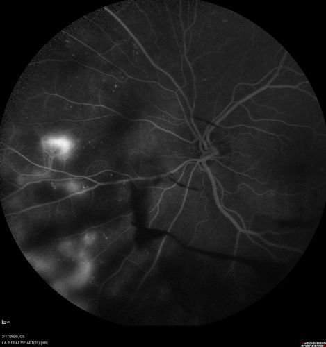 PDR and Vitreous Hemorrhage - High Risk Left Eye - Low Risk Right Eye
50 year old man with type I diabetes mellitus for 26 years.  New Vitreous Hemorrhage in the left eye.  Both eyes have NVE.  Both also have foveal hypoplasia
