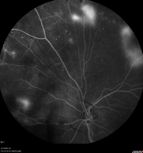 PDR and Vitreous Hemorrhage - High Risk Left Eye - Low Risk Right Eye
50 year old man with type I diabetes mellitus for 26 years.  New Vitreous Hemorrhage in the left eye.  Both eyes have NVE.  Both also have foveal hypoplasia
