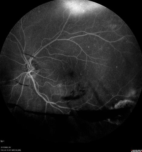 PDR and Vitreous Hemorrhage - High Risk Left Eye - Low Risk Right Eye
50 year old man with type I diabetes mellitus for 26 years.  New Vitreous Hemorrhage in the left eye.  Both eyes have NVE.  Both also have foveal hypoplasia
