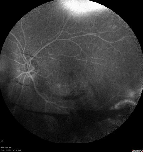 PDR and Vitreous Hemorrhage - High Risk Left Eye - Low Risk Right Eye
50 year old man with type I diabetes mellitus for 26 years.  New Vitreous Hemorrhage in the left eye.  Both eyes have NVE.  Both also have foveal hypoplasia
