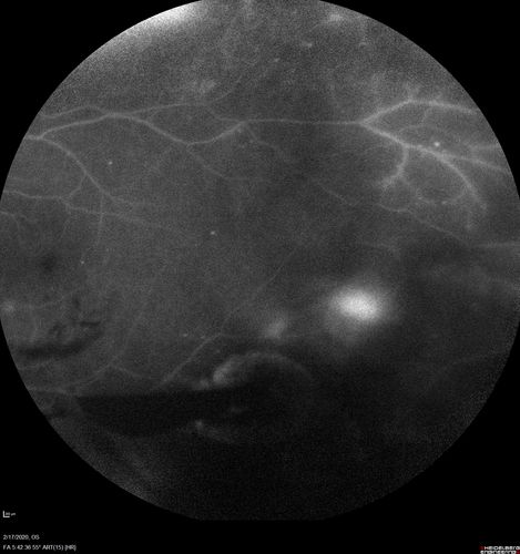 PDR and Vitreous Hemorrhage - High Risk Left Eye - Low Risk Right Eye
50 year old man with type I diabetes mellitus for 26 years.  New Vitreous Hemorrhage in the left eye.  Both eyes have NVE.  Both also have foveal hypoplasia
