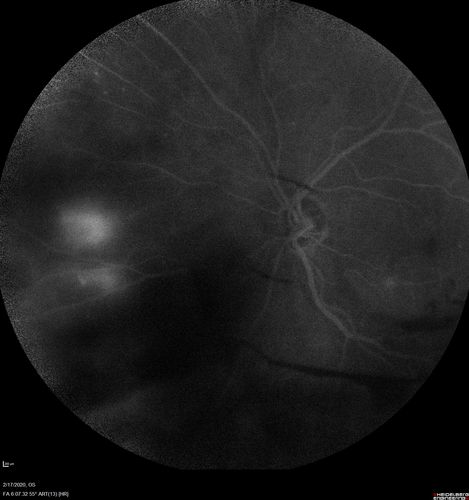 PDR and Vitreous Hemorrhage - High Risk Left Eye - Low Risk Right Eye
50 year old man with type I diabetes mellitus for 26 years.  New Vitreous Hemorrhage in the left eye.  Both eyes have NVE.  Both also have foveal hypoplasia
