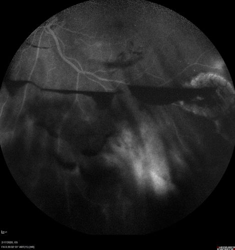 PDR and Vitreous Hemorrhage - High Risk Left Eye - Low Risk Right Eye
50 year old man with type I diabetes mellitus for 26 years.  New Vitreous Hemorrhage in the left eye.  Both eyes have NVE.  Both also have foveal hypoplasia
