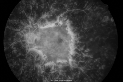 PDR with heavy PRP laser and worsening macular edema late fa
51-year-old woman has had extensive laser in both eyes done years ago elsewhere. Her left eye has gradually been declining with macular edema.
VISUAL ACUITY: OD 20/40, OS 20/40
