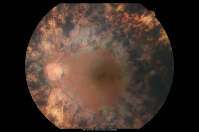 PDR with heavy PRP laser and worsening macular edema 
51-year-old woman has had extensive laser in both eyes done years ago elsewhere. Her left eye has gradually been declining with macular edema.
VISUAL ACUITY: OD 20/40, OS 20/40
