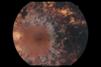 PDR with heavy PRP laser and worsening macular edema 
51-year-old woman has had extensive laser in both eyes done years ago elsewhere. Her left eye has gradually been declining with macular edema.
VISUAL ACUITY: OD 20/40, OS 20/40
