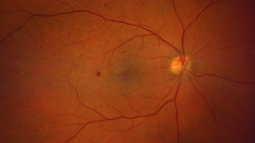 Proliferative diabetic retinopathy with vitreous hemorrhage
53 year old man with foggy vision in the left eye for one day.  VA 20/25 OD, 20/40 OS.  Diabetes for 10 years.  Type II
