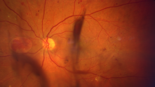 Proliferative diabetic retinopathy with vitreous hemorrhage
53 year old man with foggy vision in the left eye for one day.  VA 20/25 OD, 20/40 OS.  Diabetes for 10 years.  Type II
