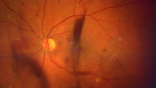 Proliferative diabetic retinopathy with vitreous hemorrhage
53 year old man with foggy vision in the left eye for one day.  VA 20/25 OD, 20/40 OS.  Diabetes for 10 years.  Type II

