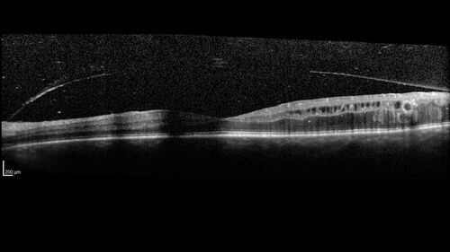 Proliferative diabetic retinopathy with vitreous hemorrhage
53 year old man with foggy vision in the left eye for one day.  VA 20/25 OD, 20/40 OS.  Diabetes for 10 years.  Type II
