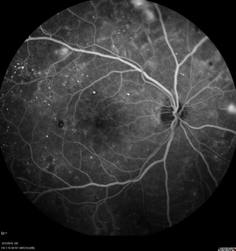 Proliferative diabetic retinopathy with vitreous hemorrhage
53 year old man with foggy vision in the left eye for one day.  VA 20/25 OD, 20/40 OS.  Diabetes for 10 years.  Type II
