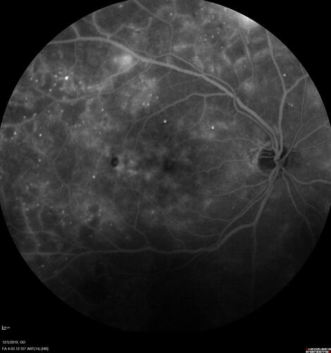 Proliferative diabetic retinopathy with vitreous hemorrhage
53 year old man with foggy vision in the left eye for one day.  VA 20/25 OD, 20/40 OS.  Diabetes for 10 years.  Type II
