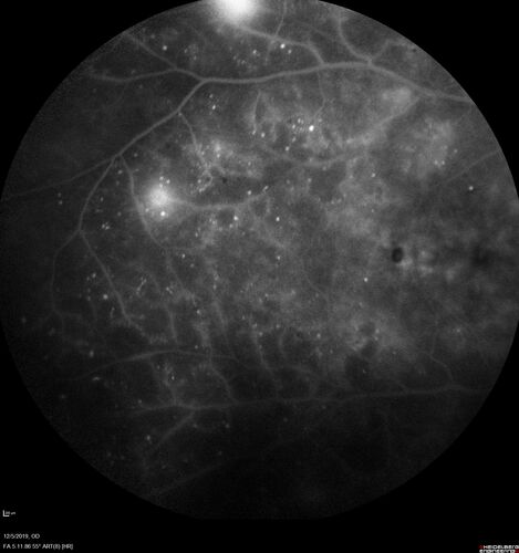 Proliferative diabetic retinopathy with vitreous hemorrhage
53 year old man with foggy vision in the left eye for one day.  VA 20/25 OD, 20/40 OS.  Diabetes for 10 years.  Type II
