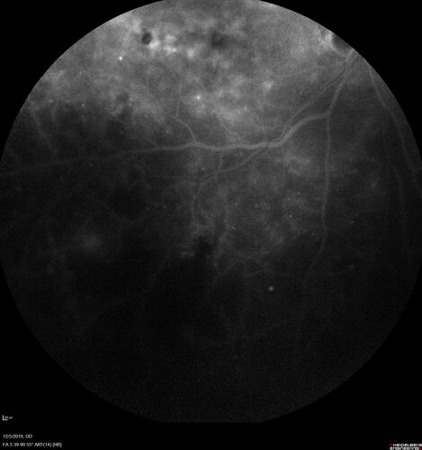 Proliferative diabetic retinopathy with vitreous hemorrhage
53 year old man with foggy vision in the left eye for one day.  VA 20/25 OD, 20/40 OS.  Diabetes for 10 years.  Type II
