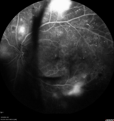 Proliferative diabetic retinopathy with vitreous hemorrhage
53 year old man with foggy vision in the left eye for one day.  VA 20/25 OD, 20/40 OS.  Diabetes for 10 years.  Type II
