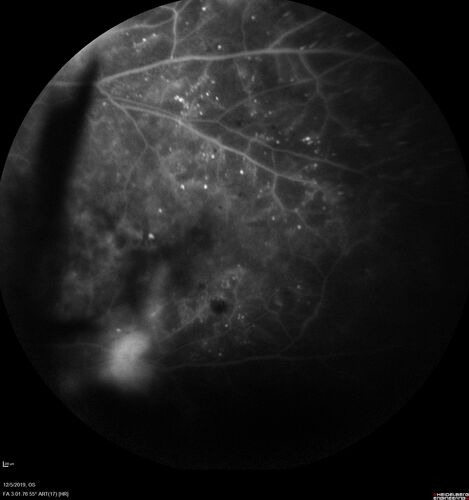 Proliferative diabetic retinopathy with vitreous hemorrhage
53 year old man with foggy vision in the left eye for one day.  VA 20/25 OD, 20/40 OS.  Diabetes for 10 years.  Type II
