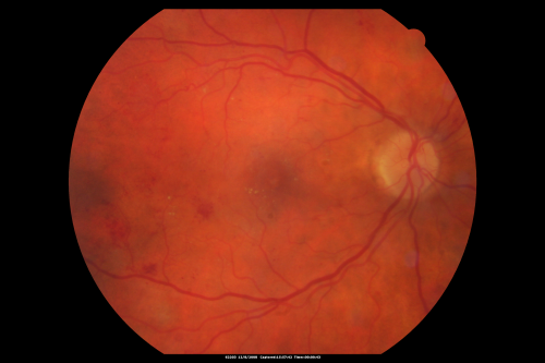 Proliferative Diabetic Retinopathy - Vitreous Hemorrhage and Tractional Retinal Detachment Left Eye
52-year-old man has been diabetic for nineteen years developed substantial vision loss over the last month or two. OD 20/70, OS 20/200.
