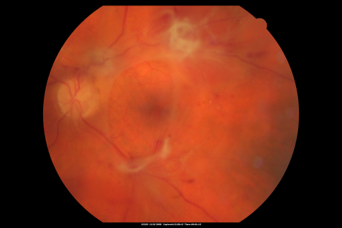 Proliferative Diabetic Retinopathy - Vitreous Hemorrhage and Tractional Retinal Detachment Left Eye
52-year-old man has been diabetic for nineteen years developed substantial vision loss over the last month or two. OD 20/70, OS 20/200.
Keywords: fibrosis