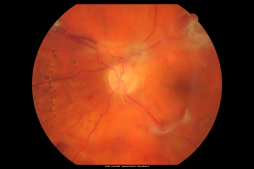 Proliferative Diabetic Retinopathy - Vitreous Hemorrhage and Tractional Retinal Detachment Left Eye
52-year-old man has been diabetic for nineteen years developed substantial vision loss over the last month or two. OD 20/70, OS 20/200.
Keywords: fibrosis