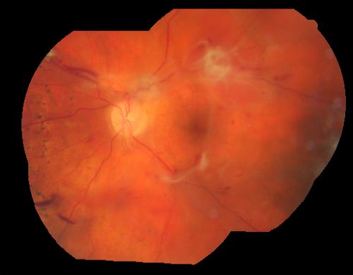 Proliferative Diabetic Retinopathy - Vitreous Hemorrhage and Tractional Retinal Detachment Left Eye
52-year-old man has been diabetic for nineteen years developed substantial vision loss over the last month or two. OD 20/70, OS 20/200.
Mots-clés: fibrosis