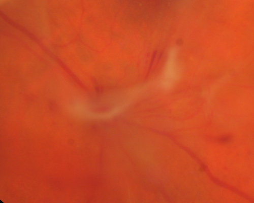 Proliferative Diabetic Retinopathy - Vitreous Hemorrhage and Tractional Retinal Detachment Left Eye
52-year-old man has been diabetic for nineteen years developed substantial vision loss over the last month or two. OD 20/70, OS 20/200.
Keywords: fibrosis