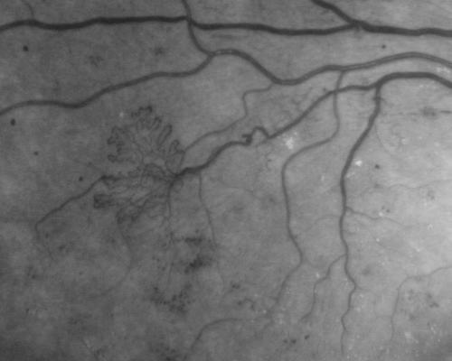 Proliferative Diabetic Retinopathy - Vitreous Hemorrhage and Tractional Retinal Detachment Left Eye
52-year-old man has been diabetic for nineteen years developed substantial vision loss over the last month or two. OD 20/70, OS 20/200.
