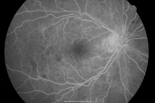 Proliferative Diabetic Retinopathy - Vitreous Hemorrhage and Tractional Retinal Detachment Left Eye
52-year-old man has been diabetic for nineteen years developed substantial vision loss over the last month or two. OD 20/70, OS 20/200.
