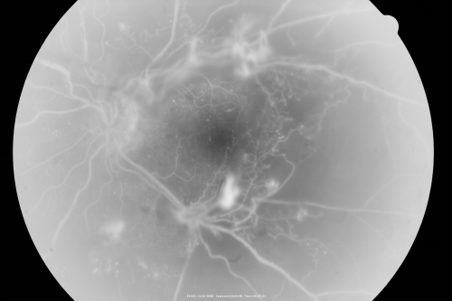 Proliferative Diabetic Retinopathy - Vitreous Hemorrhage and Tractional Retinal Detachment Left Eye
52-year-old man has been diabetic for nineteen years developed substantial vision loss over the last month or two. OD 20/70, OS 20/200.
Keywords: fibrosis