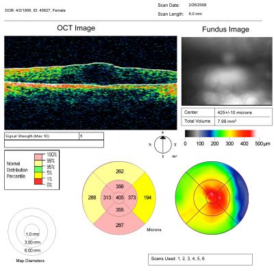PDR with heavy PRP laser and worsening macular edema map
51-year-old woman has had extensive laser in both eyes done years ago elsewhere. Her left eye has gradually been declining with macular edema.
VISUAL ACUITY: OD 20/40, OS 20/40
