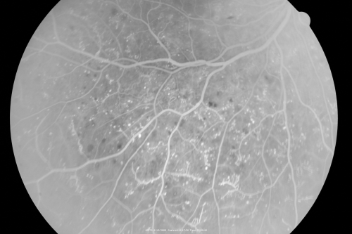 Proliferative Diabetic Retinopathy in patient with Moyamoya Disease
28-year-old womandiabetic since age nine, and she also has had multiple strokes.  OD is 20/30, OS is 20/30.
