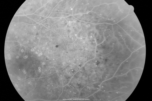 Proliferative Diabetic Retinopathy in patient with Moyamoya Disease
28-year-old womandiabetic since age nine, and she also has had multiple strokes.  OD is 20/30, OS is 20/30.
