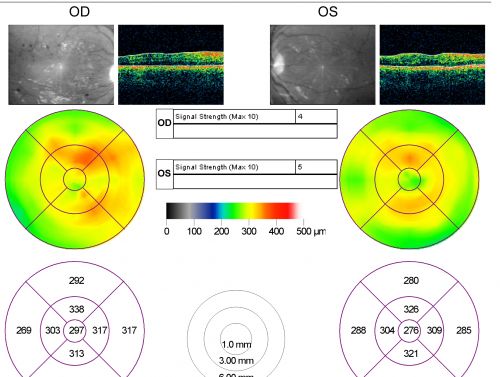 Proliferative Diabetic Retinopathy in patient with Moyamoya Disease
28-year-old womandiabetic since age nine, and she also has had multiple strokes.  OD is 20/30, OS is 20/30.
