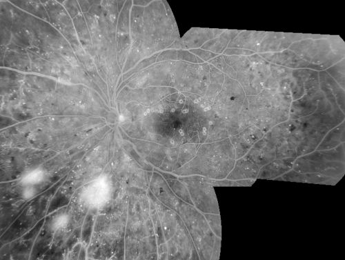 Proliferative Diabetic Retinopathy in patient with Moyamoya Disease
28-year-old womandiabetic since age nine, and she also has had multiple strokes.  OD is 20/30, OS is 20/30.
