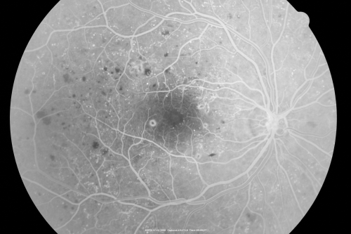 Proliferative Diabetic Retinopathy in patient with Moyamoya Disease
28-year-old womandiabetic since age nine, and she also has had multiple strokes.  OD is 20/30, OS is 20/30.
