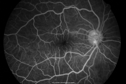 Proliferative Diabetic Retinopathy Both Eyes - Vitreous Hemorrahge Left Eye
67-year-old man has proliferative diabetic retinopathy in both eyes with vitreous hemorrhage in the left eye.  He has had pan retinal laser in the left eye.  The vitreous hemorrhage has been there for greater than two years and his vision is still hazy.  He takes Lumigan in both eyes for his glaucoma.  

VISUAL ACUITY:  OD 20/40,  OS 20/40
